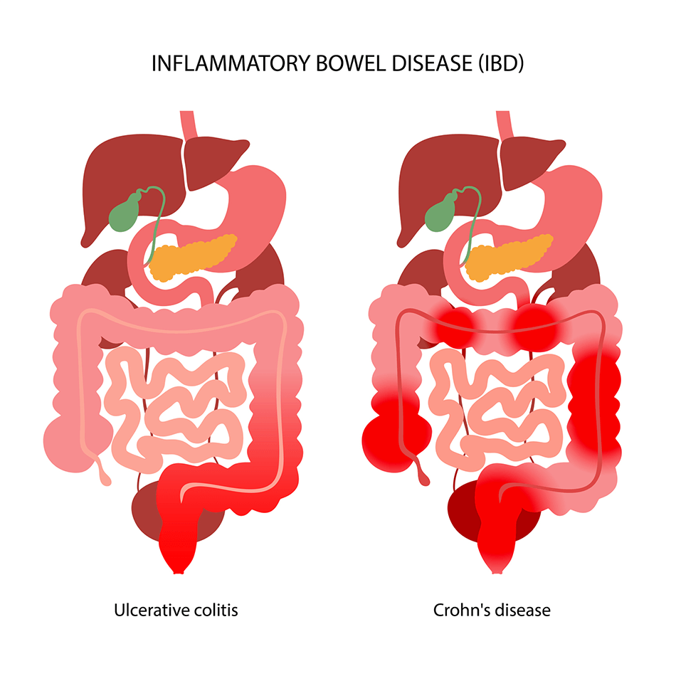 Inflammatory Bowel Disease (IBD)