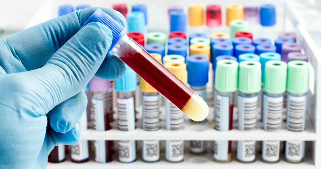 HrC: a simple blood test that can diagnose cancer BEFORE you get it